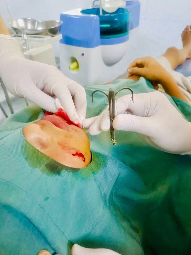 Đi câu cá, lưỡi câu móc vào má- Ảnh 2.