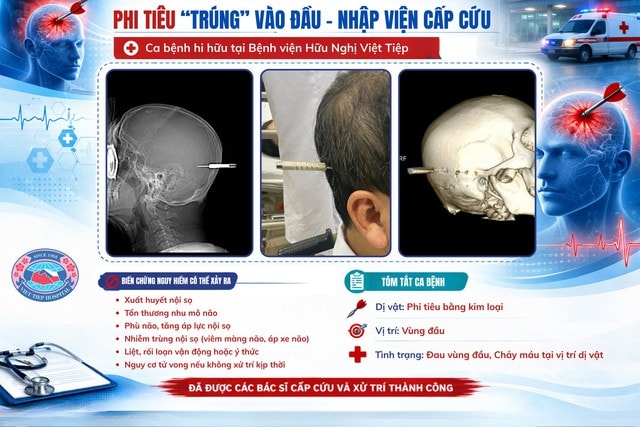 Người đàn ông bị phi tiêu cắm trúng đầu nhập viện khẩn cấp- Ảnh 1.