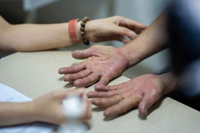 Mới nắng đầu mùa, bệnh da liễu tăng mạnh, bác sĩ chỉ cách phòng tránh- Ảnh 2.