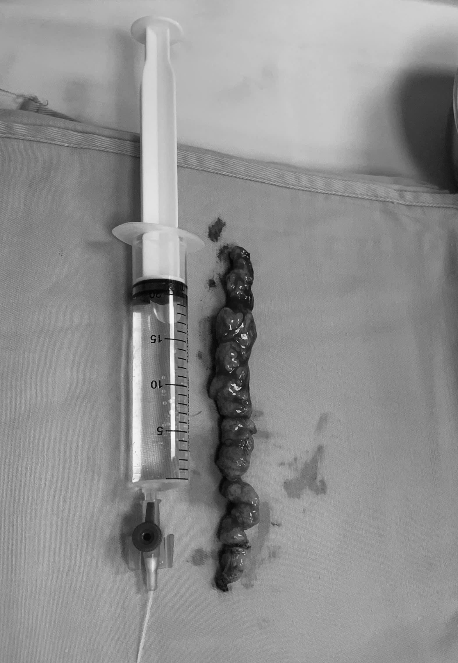 Tưởng thoái hóa cột sống, người phụ nữ phát hiện khối u tủy 15cm suýt gây liệt- Ảnh 1.