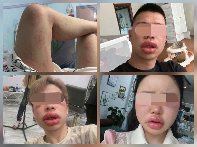 Sưng mắt, môi sau khi ăn bánh trứng kiến: Đặc sản hay 'thủ phạm'?- Ảnh 1.