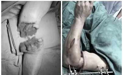 Hồi sinh cánh tay đứt lìa dập nát trong 'giờ vàng'- Ảnh 1.