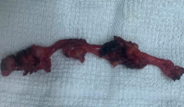 Đau âm ỉ vùng bụng, phát hiện bệnh hiếm nằm sát bàng quang- Ảnh 1.