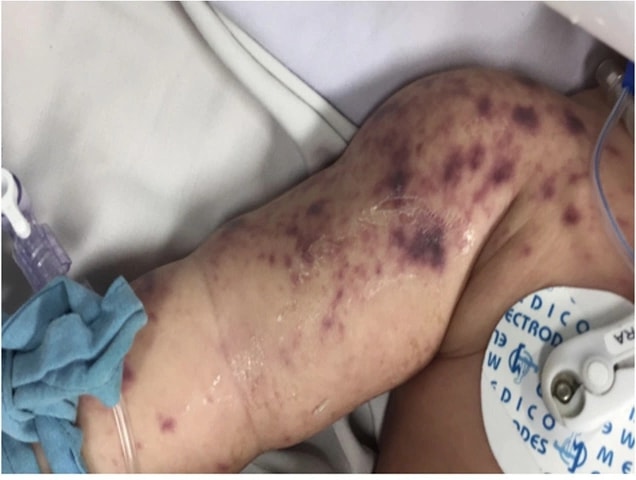 Đã có 4 ca tử vong do não mô cầu, cần biết 4 khuyến cáo phòng bệnh của Bộ Y tế- Ảnh 1.