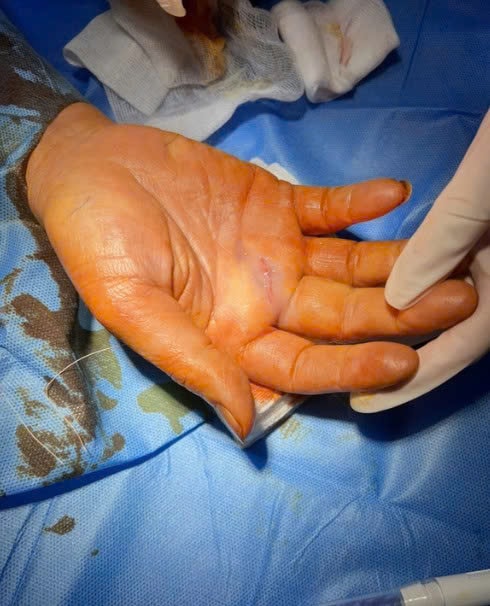 Bước tiến mới trong phẫu thuật hội chứng ống cổ tay- Ảnh 3.