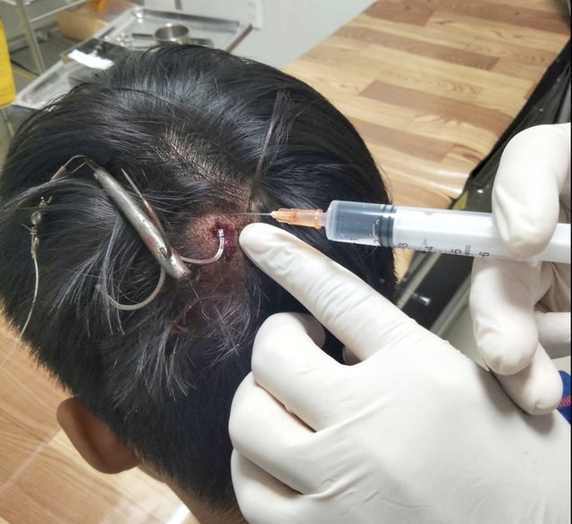 Móc câu 3 tiêu cắm sâu vào đỉnh đầu thiếu niên- Ảnh 1. Móc câu 3 tiêu cắm sâu vào đỉnh đầu thiếu niên- Ảnh 1.