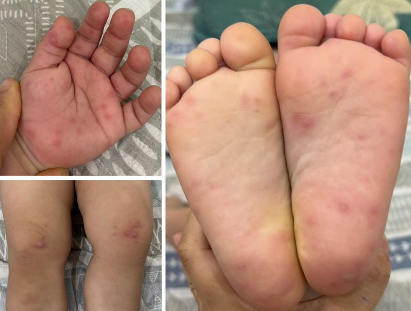 Các cấp độ bệnh tay chân miệng và dấu hiệu cảnh báo- Ảnh 3. Các cấp độ bệnh tay chân miệng và dấu hiệu cảnh báo- Ảnh 3.