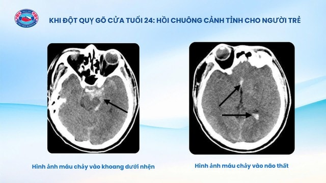 Bệnh viện Hữu nghị Việt Tiệp cứu sống bệnh nhân 24 tuổi bị đột quỵ- Ảnh 1.