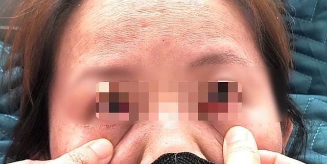 Lây sởi từ cháu gái, người phụ nữ nhập viện vì đa biến chứng- Ảnh 1. Lây sởi từ cháu gái, người phụ nữ nhập viện vì đa biến chứng- Ảnh 1.