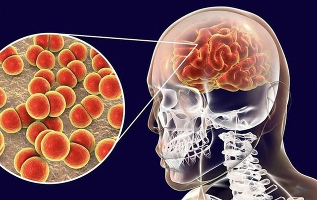 Não mô cầu gây tử vong nhanh, người dân cần làm gì để tự bảo vệ?- Ảnh 1.