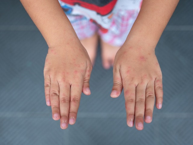 Các cấp độ bệnh tay chân miệng và dấu hiệu cảnh báo- Ảnh 2. Các cấp độ bệnh tay chân miệng và dấu hiệu cảnh báo- Ảnh 2.