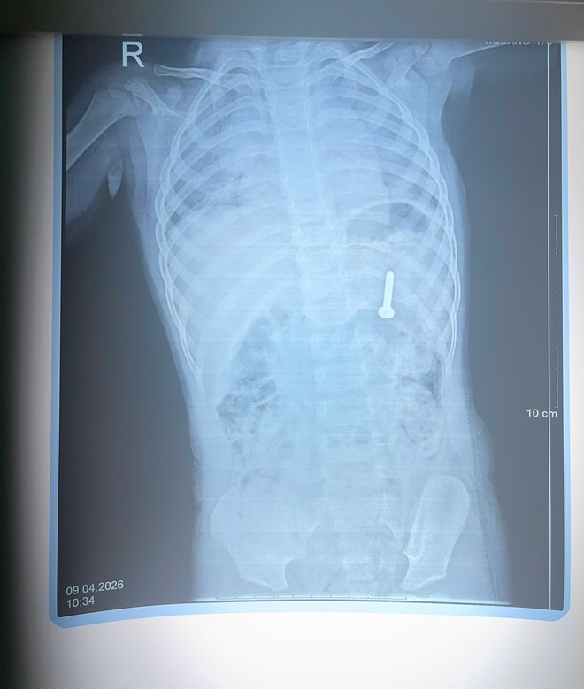 Bé 21 tháng tuổi nuốt phải đinh vít dài khoảng 2,5cm- Ảnh 1. Bé 21 tháng tuổi nuốt phải đinh vít dài khoảng 2,5cm- Ảnh 1.