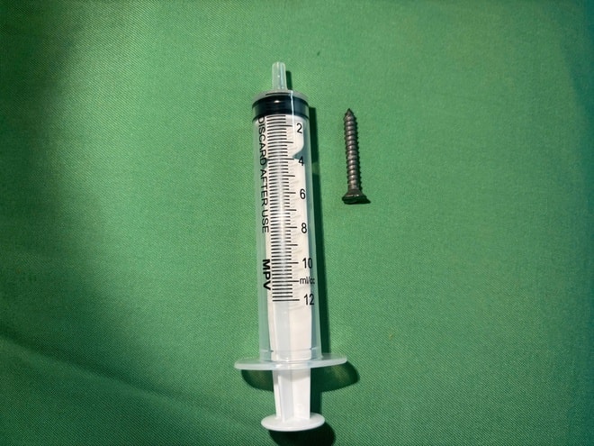 Bé 21 tháng tuổi nuốt phải đinh vít dài khoảng 2,5cm- Ảnh 2. Bé 21 tháng tuổi nuốt phải đinh vít dài khoảng 2,5cm- Ảnh 2.