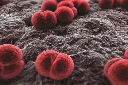 Bé 11 tuổi bị co giật do biến chứng viêm cầu thận sau viêm họng liên cầu- Ảnh 2.