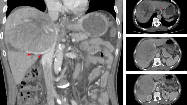Bệnh nhân ung thư gan tiên lượng sống không quá 9 tháng vẫn kiên cường điều trị sau 3 năm- Ảnh 2.