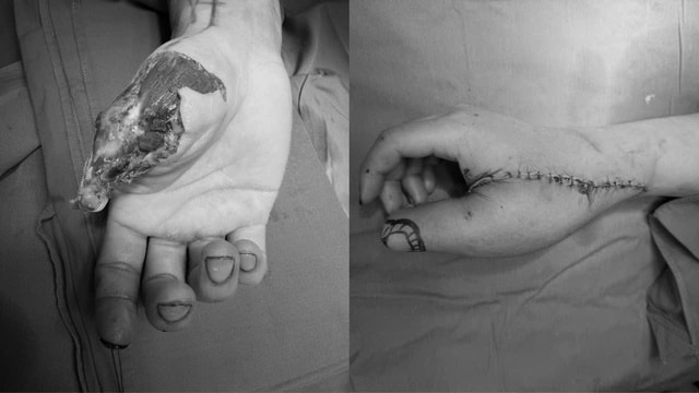 Bệnh viện Hữu nghị Việt Tiệp ứng dụng vi phẫu tái tạo bàn tay dập nát thành công- Ảnh 1.