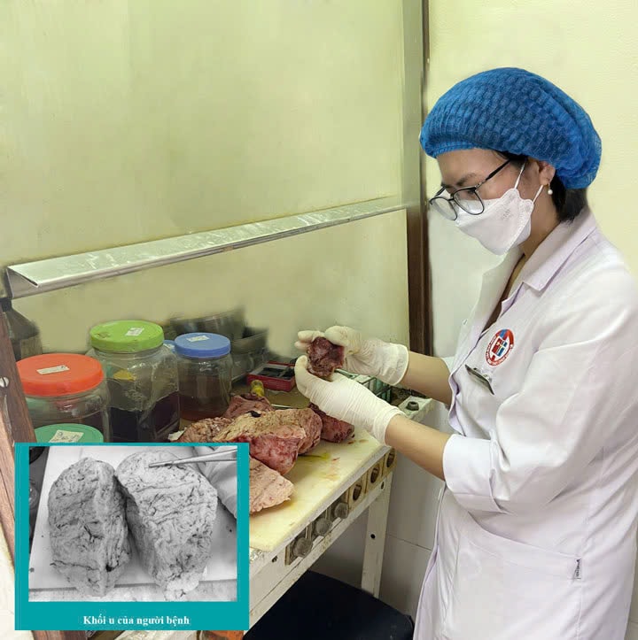 Người phụ nữ 46 tuổi mang trong mình khối u tử cung khổng lồ nặng 5kg- Ảnh 1.