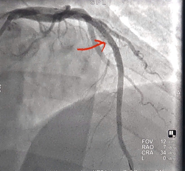 Cứu sống bệnh nhân người nước ngoài nhồi máu cơ tim cấp- Ảnh 2.