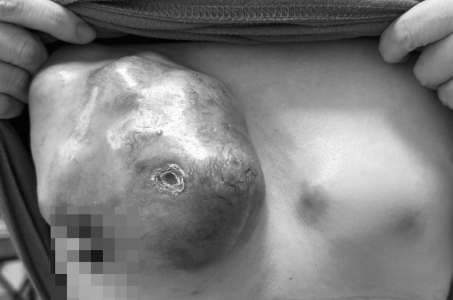 Cá thể hóa điều trị, 'chìa khóa' để bệnh nhân ung thư vú giai đoạn IV đáp ứng tốt- Ảnh 1.