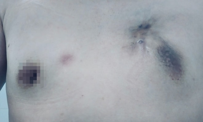 Cá thể hóa điều trị, 'chìa khóa' để bệnh nhân ung thư vú giai đoạn IV đáp ứng tốt- Ảnh 2.