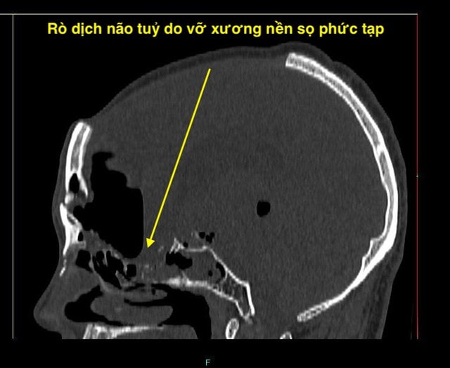 Vá rò dịch não tủy qua đường mũi, cứu 2 bệnh nhân trẻ- Ảnh 2.