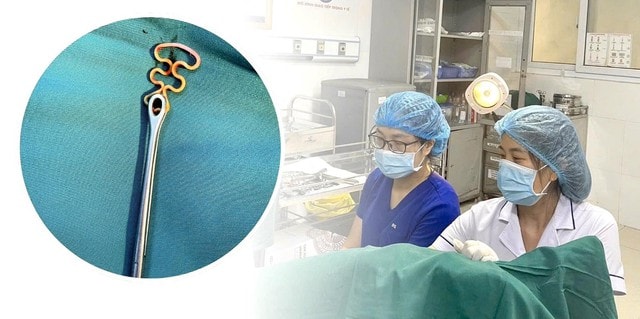 Bỏ quên vòng tránh thai suốt 30 năm, người phụ nữ 63 tuổi gặp biến chứng phụ khoa- Ảnh 1.