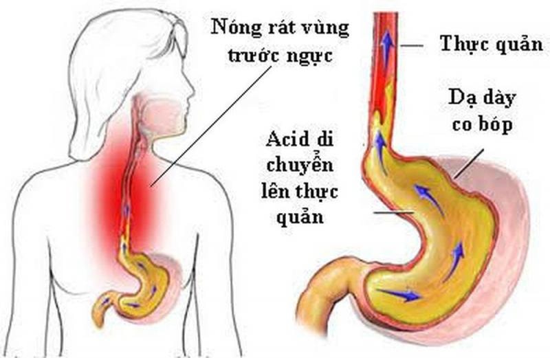 Hệ lụy khi dùng nhiều thuốc giảm tiết acid ở người trào ngược dạ dày - thực quản- Ảnh 1.