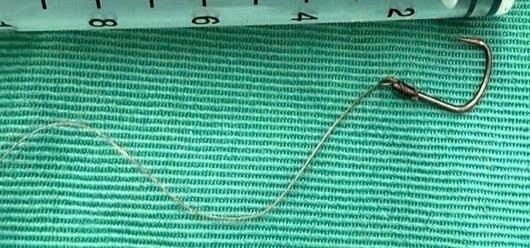 Sau ăn cá người đàn ông 46 tuổi bị mắc lưỡi câu sâu trong thực quản- Ảnh 1.