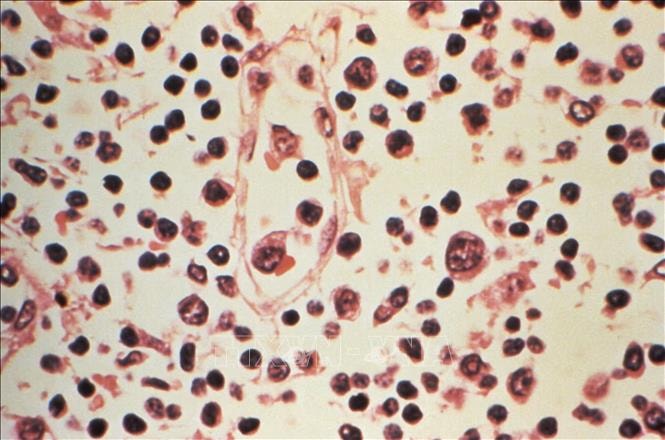 Tỷ lệ tử vong do nhiễm virus Hanta tăng cao, Chile nâng mức cảnh báo y tế- Ảnh 1. Tỷ lệ tử vong do nhiễm virus Hanta tăng cao, Chile nâng mức cảnh báo y tế- Ảnh 1.