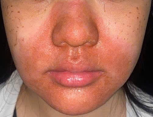 Peel da mặt làm đẹp, cô gái mọc chi chít mụn nước, vỡ chảy dịch- Ảnh 2.
