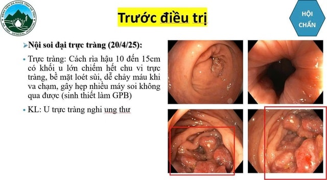 Bệnh viện Đa khoa Hà Tĩnh điều trị thành công cho bệnh nhân ung thư trực tràng di căn gan giai đoạn 4- Ảnh 1. Bệnh viện Đa khoa Hà Tĩnh điều trị thành công cho bệnh nhân ung thư trực tràng di căn gan giai đoạn 4- Ảnh 1.