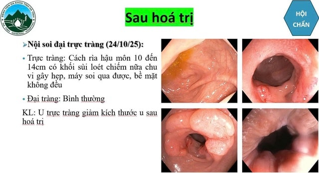 Bệnh viện Đa khoa Hà Tĩnh điều trị thành công cho bệnh nhân ung thư trực tràng di căn gan giai đoạn 4- Ảnh 2. Bệnh viện Đa khoa Hà Tĩnh điều trị thành công cho bệnh nhân ung thư trực tràng di căn gan giai đoạn 4- Ảnh 2.