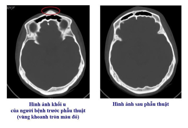 Bệnh viện Việt Nam - Thụy Điển Uông Bí phẫu thuật thành công ca u xương sọ hiếm gặp- Ảnh 1. Bệnh viện Việt Nam - Thụy Điển Uông Bí phẫu thuật thành công ca u xương sọ hiếm gặp- Ảnh 1.