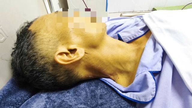 Rút 2,5 lít dịch màng phổi cứu nam bệnh nhân xơ gan suýt mất mạng vì thuốc Nam- Ảnh 2. Rút 2,5 lít dịch màng phổi cứu nam bệnh nhân xơ gan suýt mất mạng vì thuốc Nam- Ảnh 2.