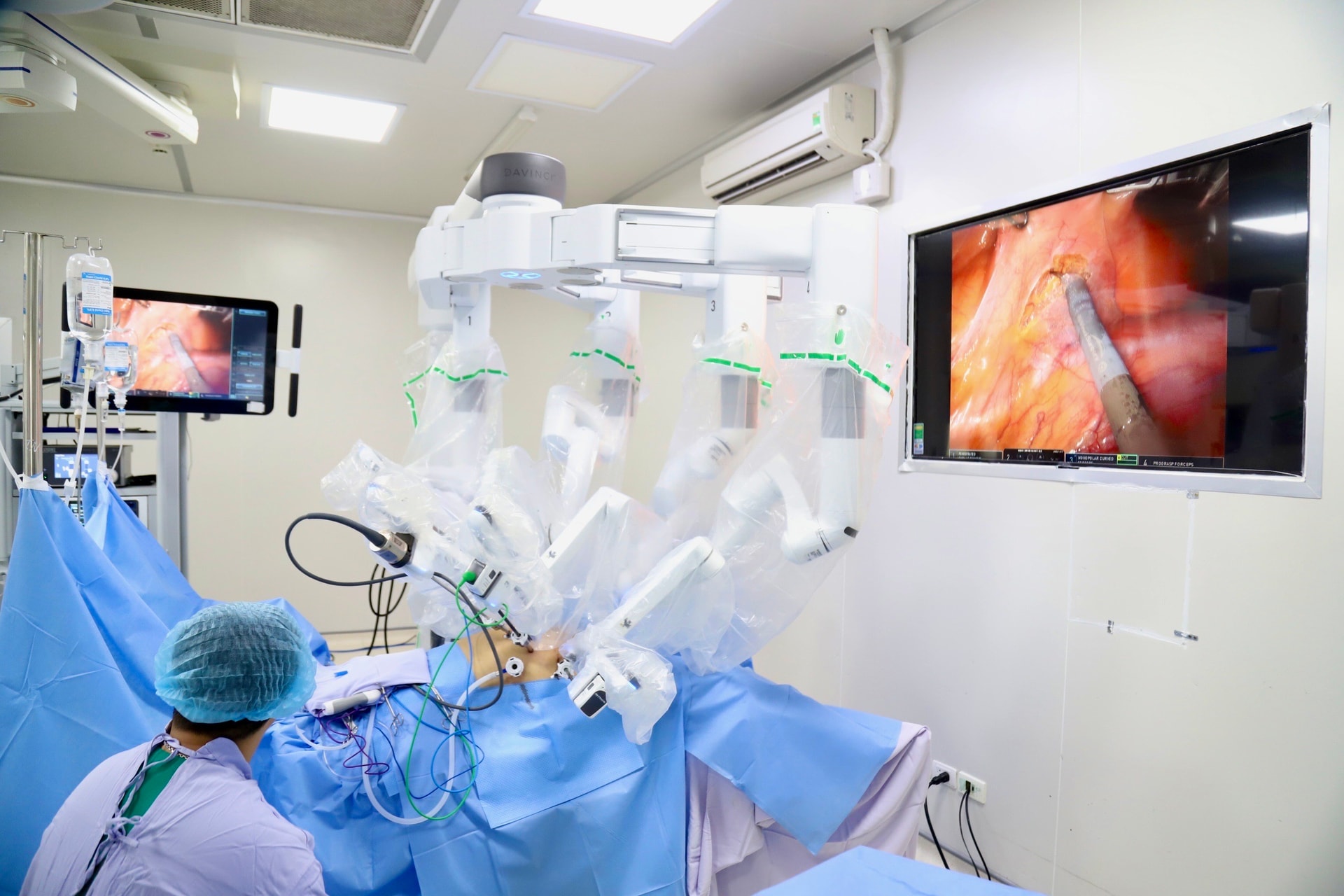 Chủ quan với dấu hiệu đi ngoài ra máu, người đàn ông 42 tuổi 'sốc' vì ung thư trực tràng- Ảnh 2. Chủ quan với dấu hiệu đi ngoài ra máu, người đàn ông 42 tuổi 'sốc' vì ung thư trực tràng- Ảnh 2.