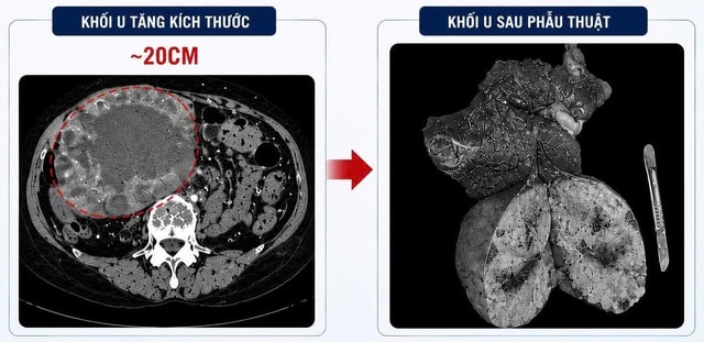 U gan 2 cm 'phình' lên 20 cm do tự điều trị bằng thuốc nam- Ảnh 1. U gan 2 cm 'phình' lên 20 cm do tự điều trị bằng thuốc nam- Ảnh 1.
