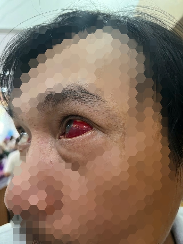 Mắt đỏ ngầu sau khi uống rượu bia, dấu hiệu cảnh báo nguy hiểm- Ảnh 2. Mắt đỏ ngầu sau khi uống rượu bia, dấu hiệu cảnh báo nguy hiểm- Ảnh 2.