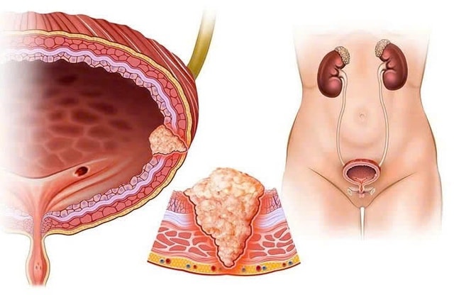 Sự hồi phục kỳ diệu của nam bệnh nhân sau 12 năm cắt toàn bộ bàng quang và tái tạo bằng ruột- Ảnh 3. Sự hồi phục kỳ diệu của nam bệnh nhân sau 12 năm cắt toàn bộ bàng quang và tái tạo bằng ruột- Ảnh 3.