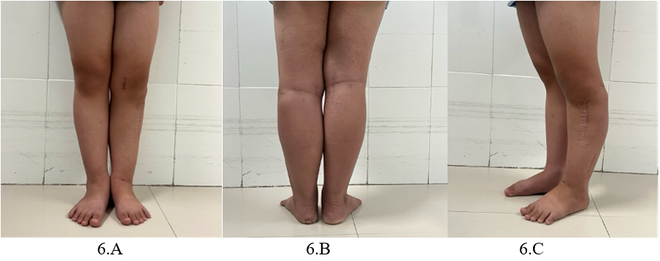 Điều trị thành công bệnh Blount biến dạng chi dưới bằng công nghệ hiện đại- Ảnh 3.