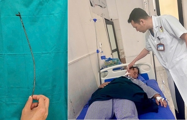 Nam thanh niên đi bắn cá bị mũi tên bật ngược đâm xuyên sâu 15cm vào vùng mặt- Ảnh 2. Nam thanh niên đi bắn cá bị mũi tên bật ngược đâm xuyên sâu 15cm vào vùng mặt- Ảnh 2.