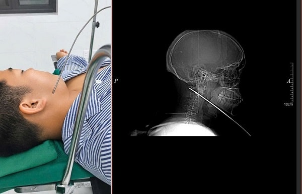 Nam thanh niên đi bắn cá bị mũi tên bật ngược đâm xuyên sâu 15cm vào vùng mặt- Ảnh 1. Nam thanh niên đi bắn cá bị mũi tên bật ngược đâm xuyên sâu 15cm vào vùng mặt- Ảnh 1.