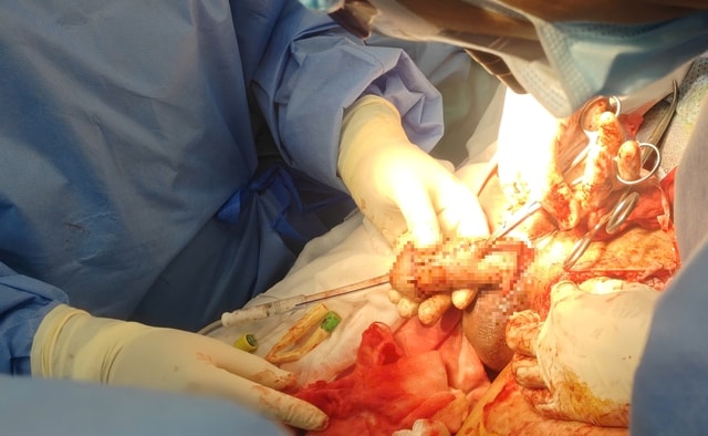 Người đàn ông mất dương vật sau bỏng điện cao thế được bác sĩ tái tạo kịp thời- Ảnh 3. Người đàn ông mất dương vật sau bỏng điện cao thế được bác sĩ tái tạo kịp thời- Ảnh 3.
