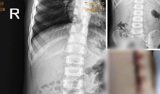 Bệnh viện Sản Nhi Nghệ An làm rõ phản ánh liên quan bệnh nhi nuốt nam châm- Ảnh 1. Bệnh viện Sản Nhi Nghệ An làm rõ phản ánh liên quan bệnh nhi nuốt nam châm- Ảnh 1.