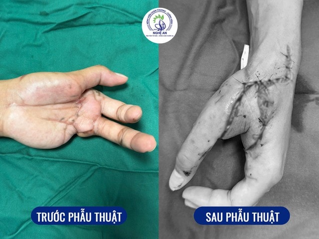 Bước tiến trong phẫu thuật vi phẫu: Chuyển vạt SCIP tự do được triển khai tại Nghệ An- Ảnh 2. Bước tiến trong phẫu thuật vi phẫu: Chuyển vạt SCIP tự do được triển khai tại Nghệ An- Ảnh 2.
