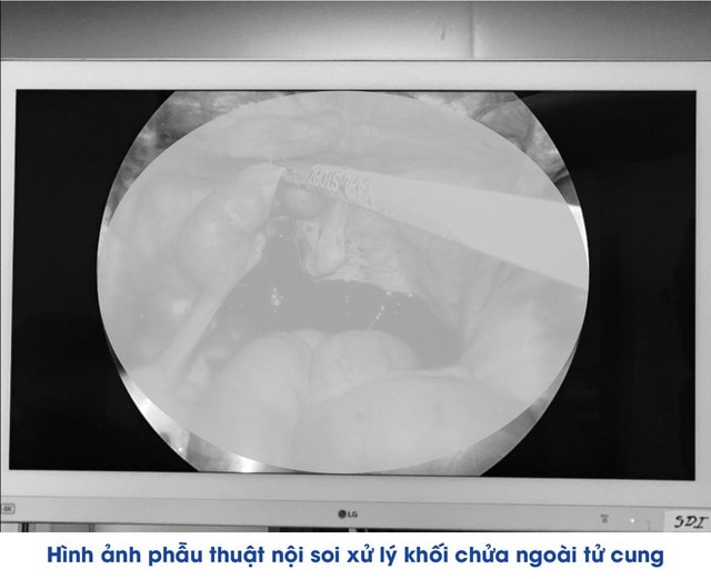 Liên tiếp cứu sống nhiều phụ nữ chửa ngoài tử cung vỡ tại Bệnh viện Đa khoa Khu vực Vân Đồn - Ảnh 2. Liên tiếp cứu sống nhiều phụ nữ chửa ngoài tử cung vỡ tại Bệnh viện Đa khoa Khu vực Vân Đồn - Ảnh 2.