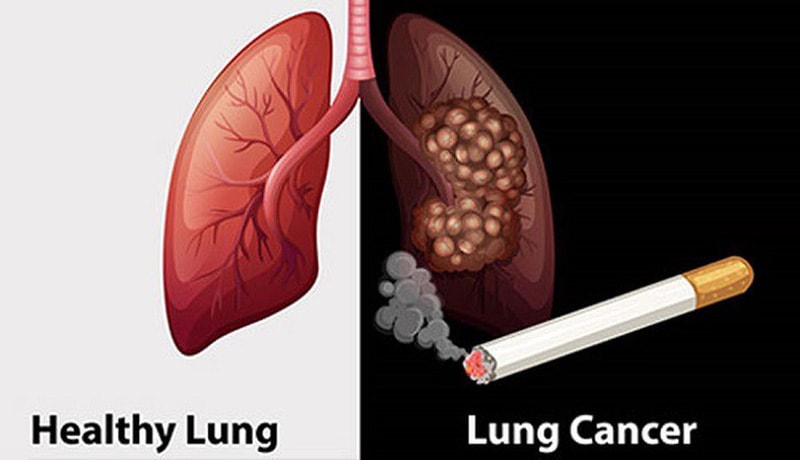 Thuốc lá gây ra 90% các trường hợp ung thư phổi- Ảnh 1. Thuốc lá gây ra 90% các trường hợp ung thư phổi- Ảnh 1.