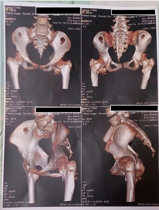 Cứng khớp sau khi ngã xe đạp, bé gái 12 tuổi phát hiện mắc hội chứng cực hiếm- Ảnh 1.
