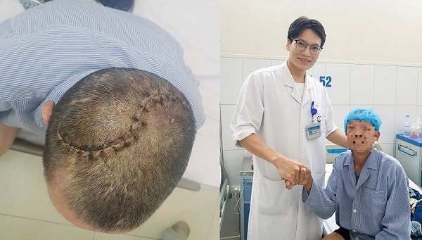 90 phút 'nghẹt thở' cứu người đàn ông bị vỡ lún sọ, tràn máu màng phổi- Ảnh 1. 90 phút 'nghẹt thở' cứu người đàn ông bị vỡ lún sọ, tràn máu màng phổi- Ảnh 1.