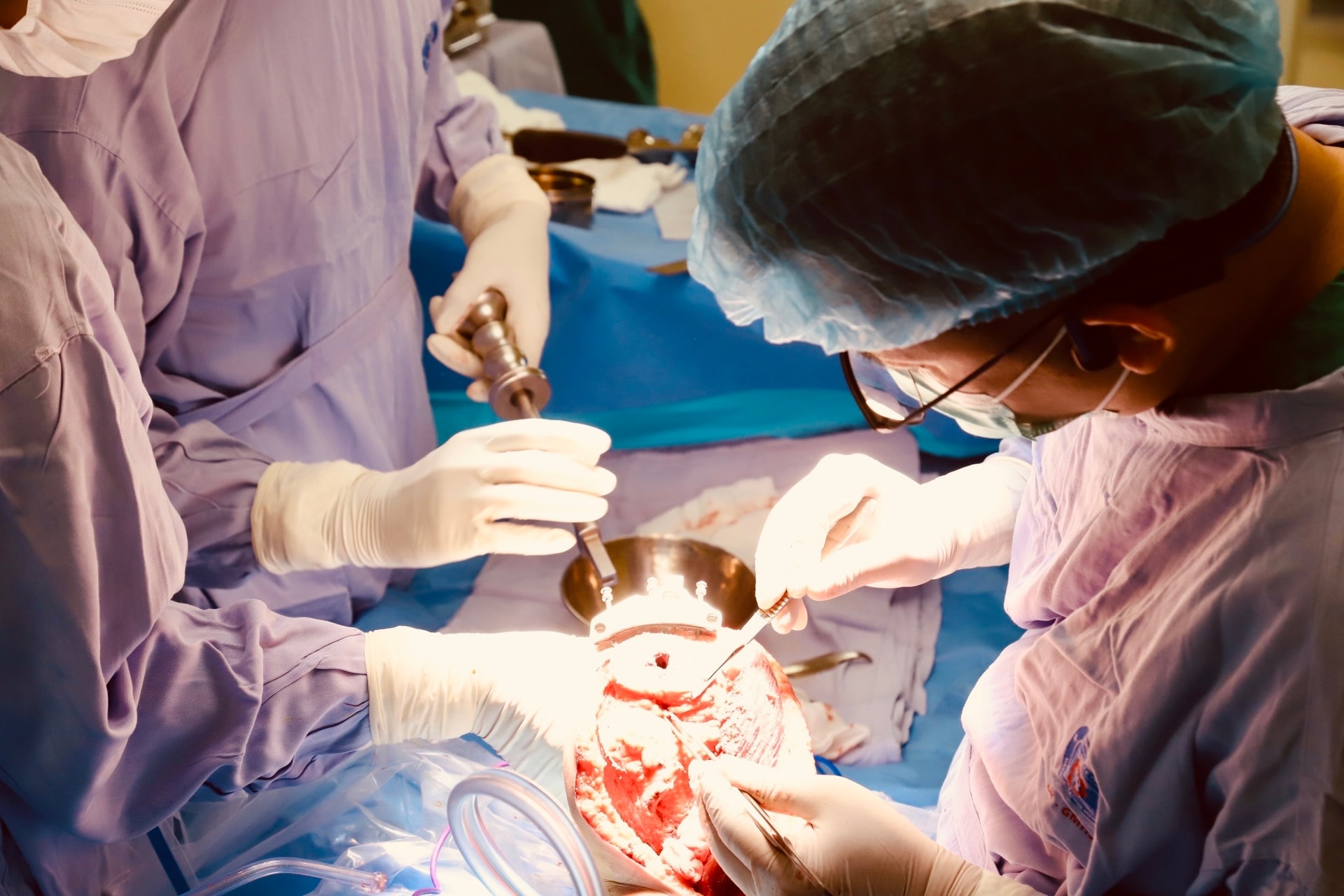 Bước tiến mới trong điều trị ung thư xương trẻ em: Thay khớp tăng trưởng nhân tạo cho bệnh nhi 6 tuổi- Ảnh 1. Bước tiến mới trong điều trị ung thư xương trẻ em: Thay khớp tăng trưởng nhân tạo cho bệnh nhi 6 tuổi- Ảnh 1.