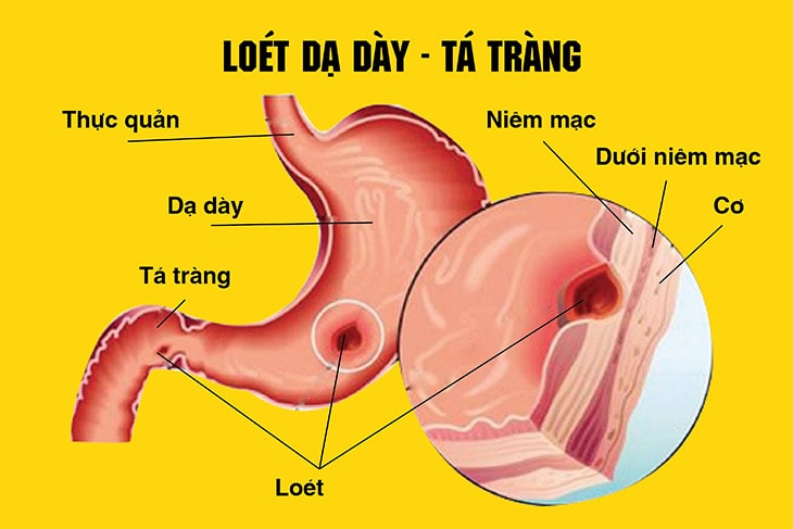 Những nguy cơ khi tự ý dùng meloxicam trị đau xương khớp - Ảnh 1.
